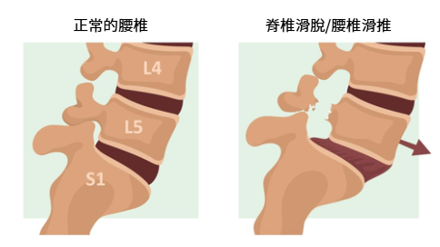 屁股痛位置-下背痠痛久站更痛:腰椎滑脫