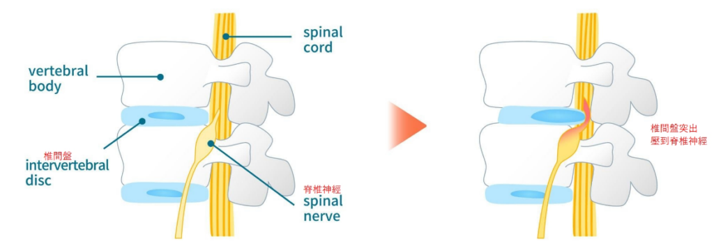 屁股痛位置-屁股有灼燒感或刺痛感:椎間盤突出